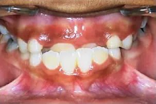 los-angeles-orthodontics-smiles-4-before porcelain veneers smile one before