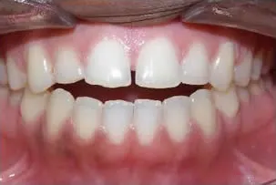 los-angeles-orthodontics-smiles-5-before porcelain veneers smile two before