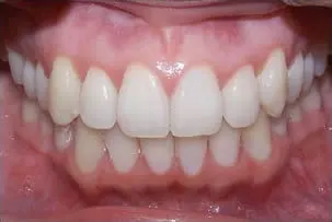 los-angeles-orthodontics-smiles-7-after dental crowns after