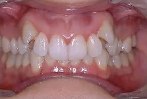 los-angeles-orthodontics-smiles-7-before dental crowns before